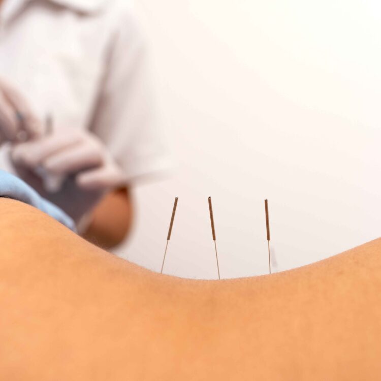 Dry needling